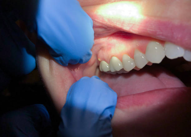 Best Dentist for Tooth Abscess  in Glen Alpine, NC
